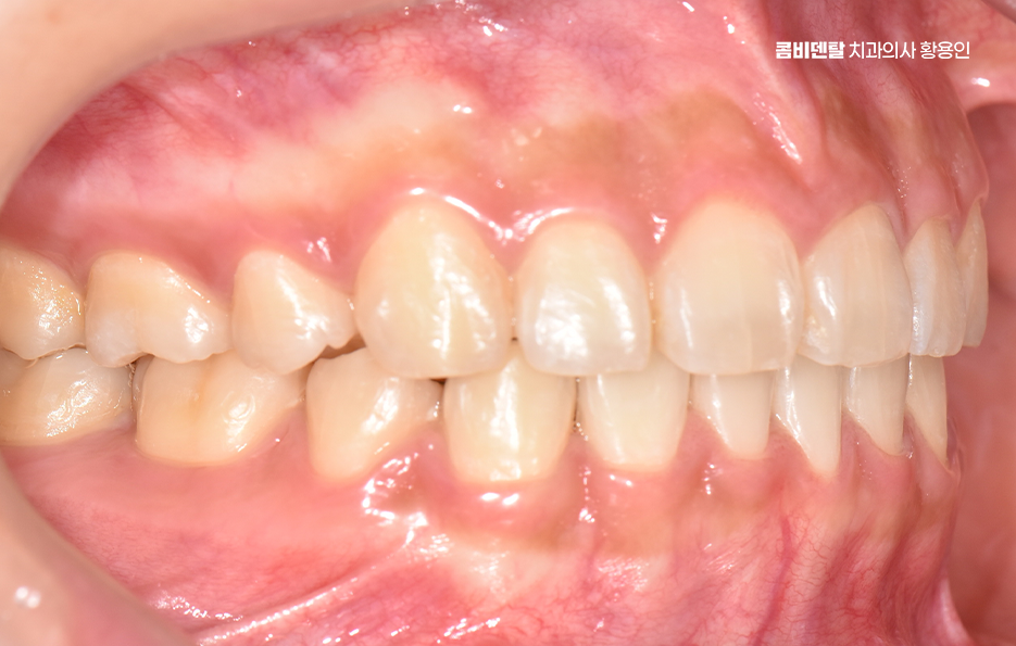 과개교합 교정 후 얼굴형 얼마나 바뀌나요 관련 이미지 10