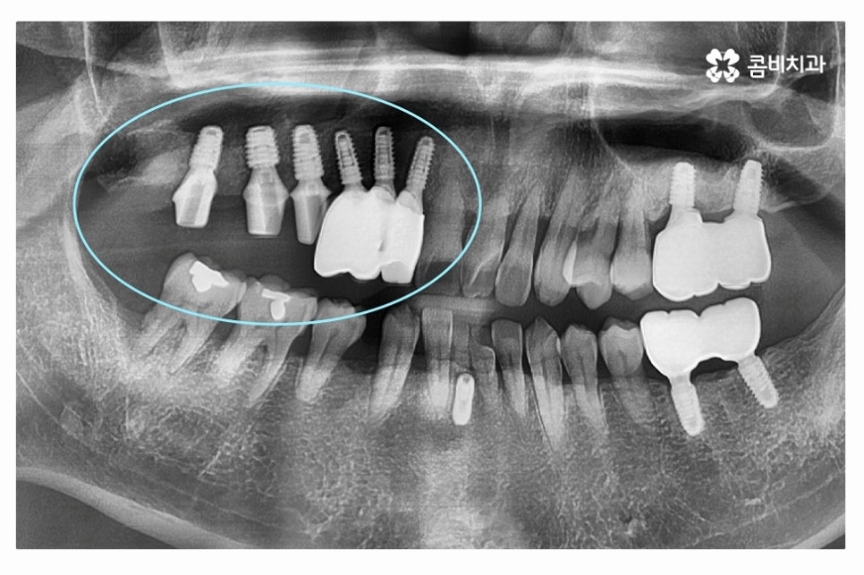 임플란트 수술 신중하게 결정하려면 관련 이미지 8