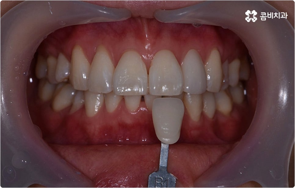 치아미백시술 관심있다면 관련 이미지 7