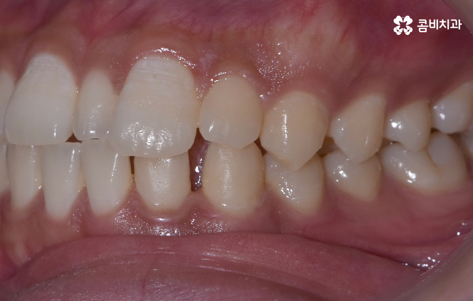 앞니만 교정 과잉치 뽑아서 해결했어요 관련 이미지 3