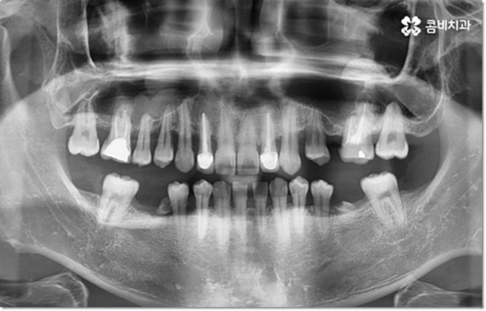 아랫니임플란트 주의할것들은? 관련 이미지 1