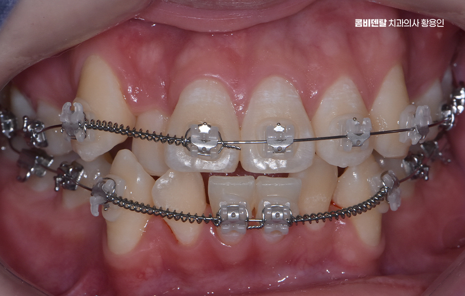 송곳니 덧니 발치 이럴때 해당되네요 관련 이미지 7