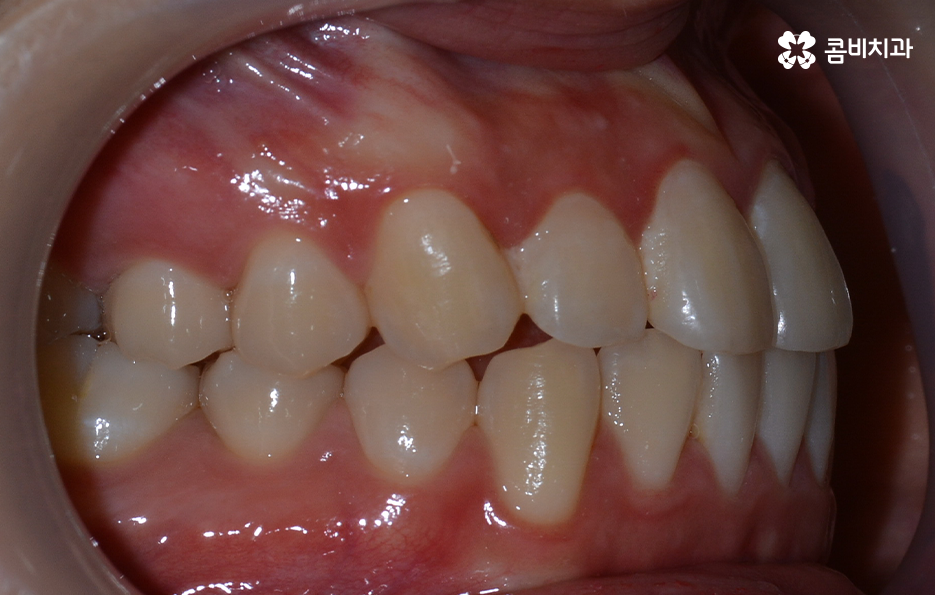 돌출입발치교정 기대해봐도 될까요 관련 이미지 2