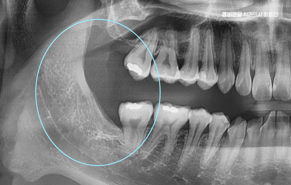 How to Systematically Prepare for Wisdom Tooth Extraction Due to Cavities image 9