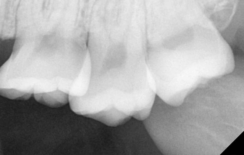 사랑니발치통증 이렇게 해야 쉬워져요 관련 이미지 4
