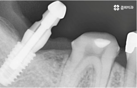 명동치과 타고난 이의 수명은 관련 이미지 15