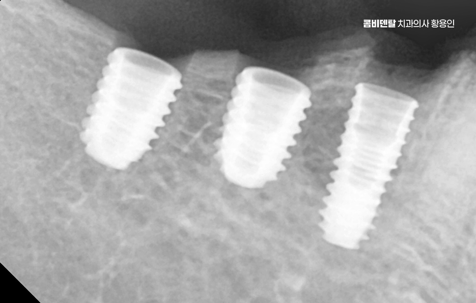 어금니 임플란트 안하면 후회하게 되는걸까 관련 이미지 3