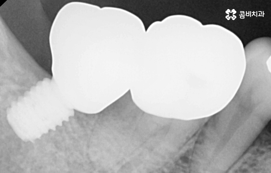 임플란트 치료기간 어느정도 걸리고 치과에는 몇번 가나요 관련 이미지 11