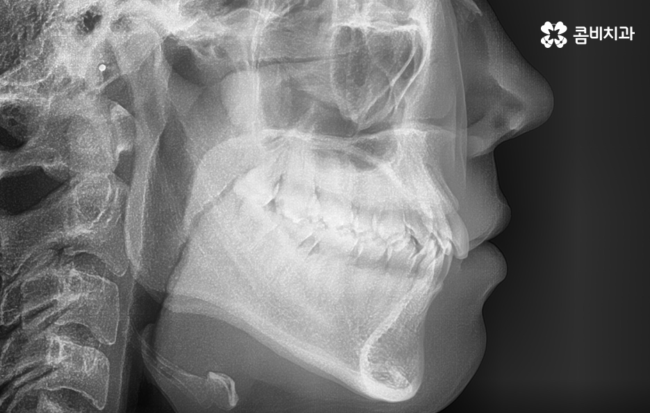 비발치치아교정 고민되는데 발치하면 안좋나요 관련 이미지 1