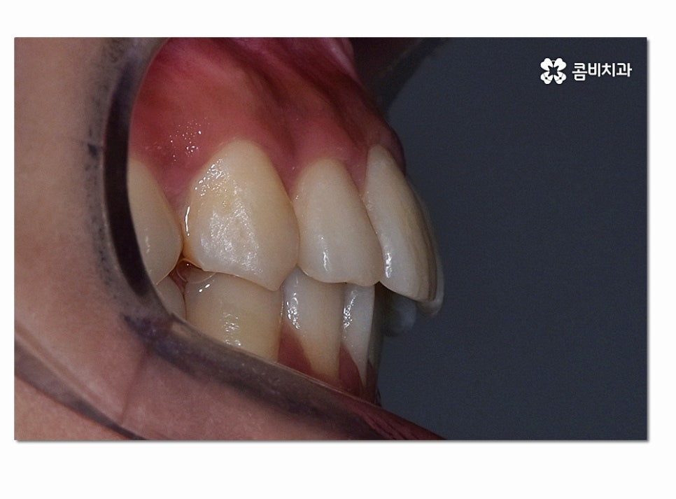 앞니 부분교정 오래 걸리지 않고 원하는 부위만 관련 이미지 13