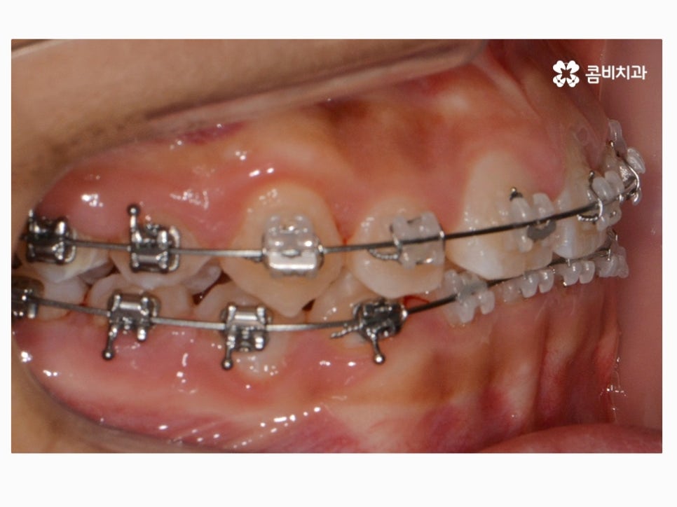 과개교합교정 어릴때 고쳐주면 좋은 사례 관련 이미지 9