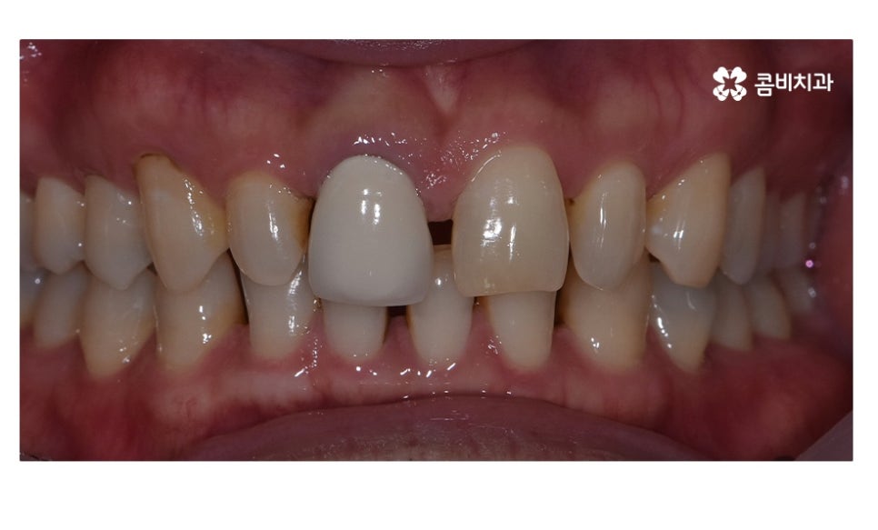 무삭제라미네이트 포인트부터 잘 알고 시작하려면 관련 이미지 1