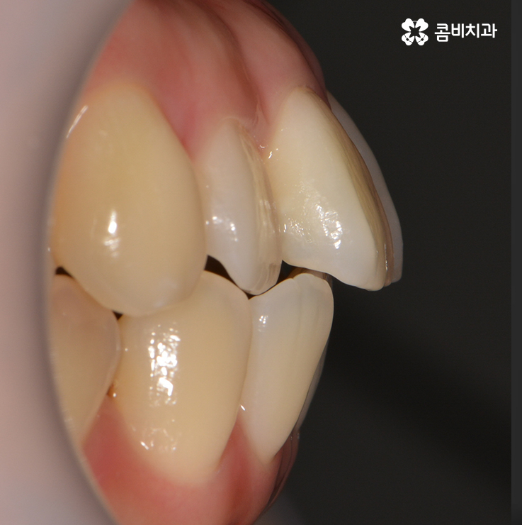 앞니치아교정 자연스러운 결과를 위해 알아둬야 할 점 관련 이미지 2