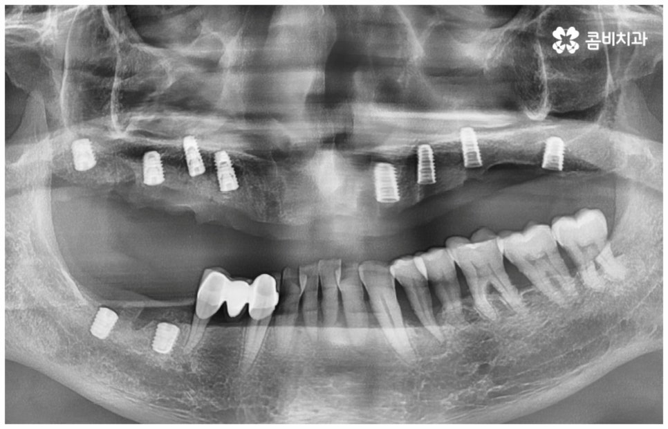 임플란트수명 연장하려면? 관련 이미지 10