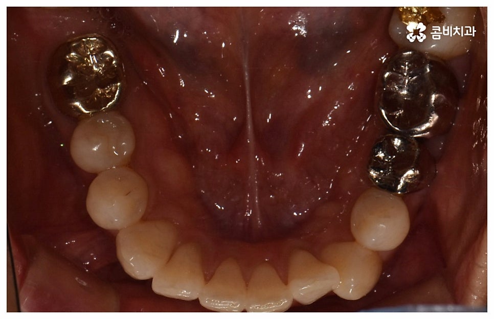 중년치아교정 원한다면 관련 이미지 6