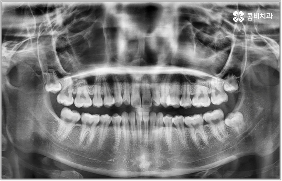 돌출입치아교정 언제가 적기인가요? 관련 이미지 2