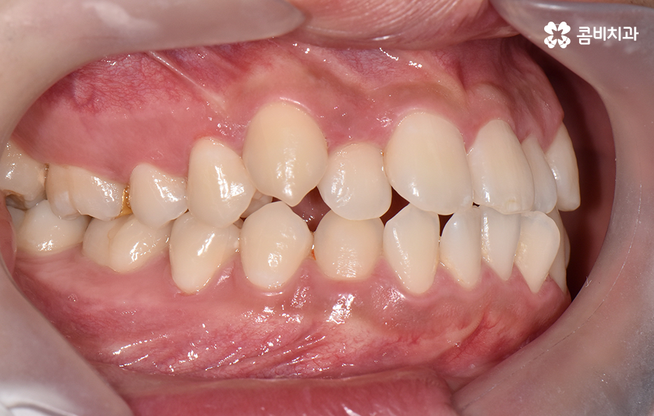 30대 치아교정 빨리 끝내고 싶어요 관련 이미지 2