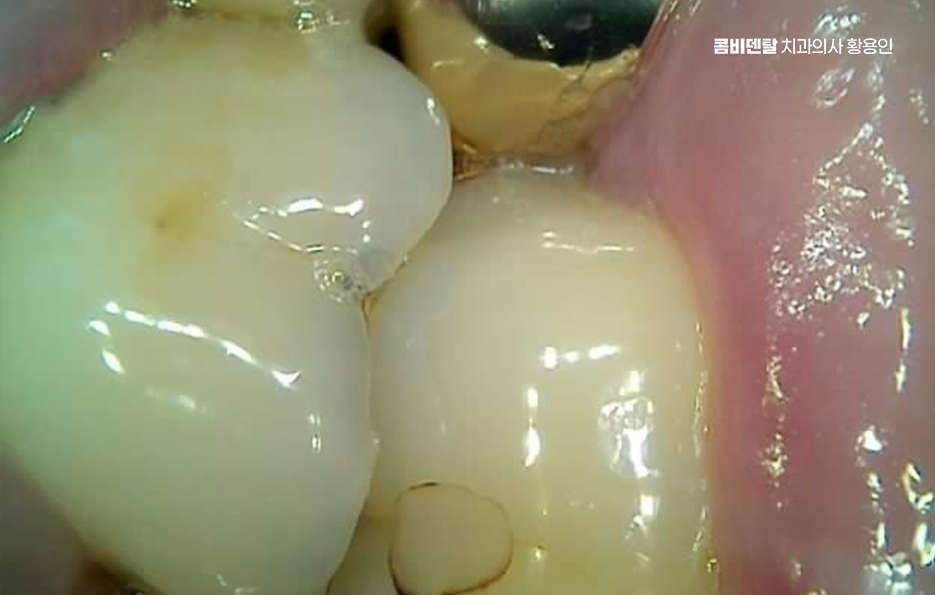 충치 치아 깨짐 시점이 관건이라면 관련 이미지 5