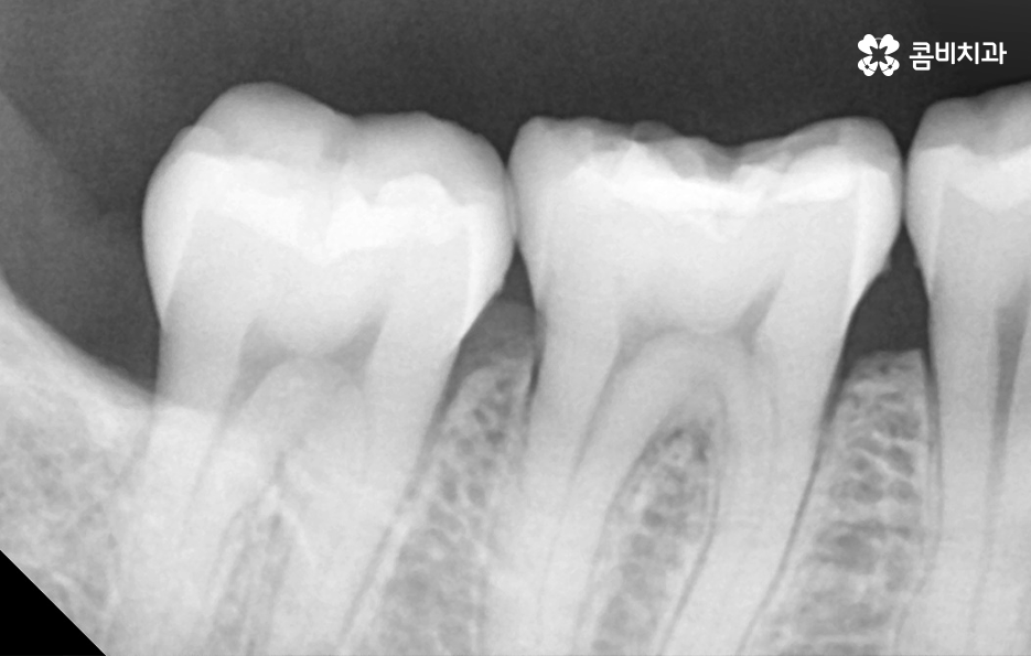 어금니 레진 깨짐 변색 안아파도 이렇게 대처하세요 관련 이미지 10