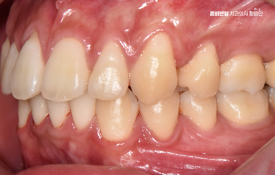 Can Crooked Lower Teeth Be Improved Without Extraction? image 9