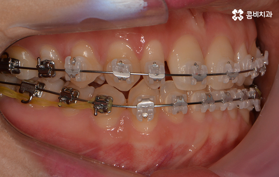 앞니 깨짐 치료와 교정이 병행되었던 사례 관련 이미지 6