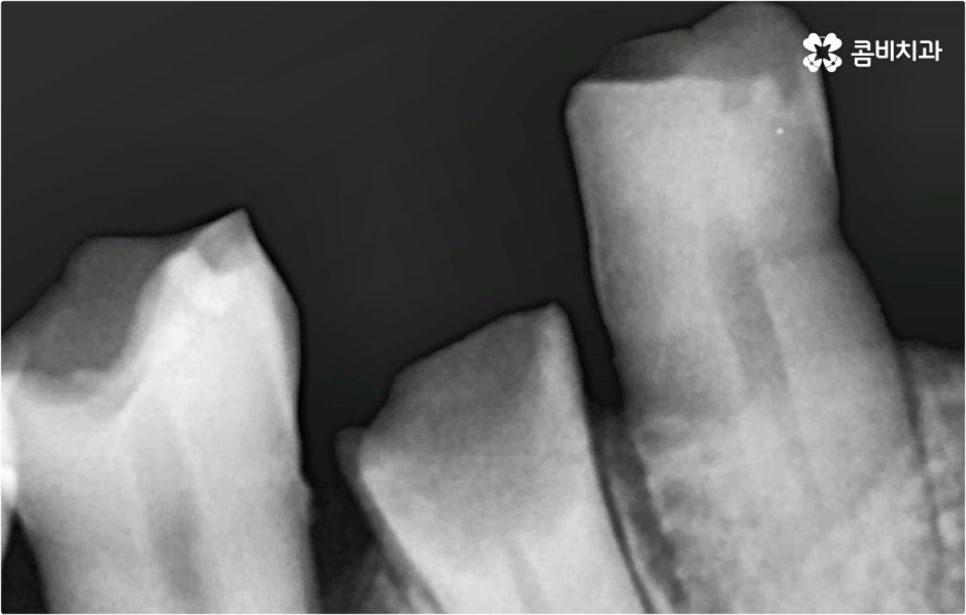 전악임플란트 고려할 사항들은 관련 이미지 5