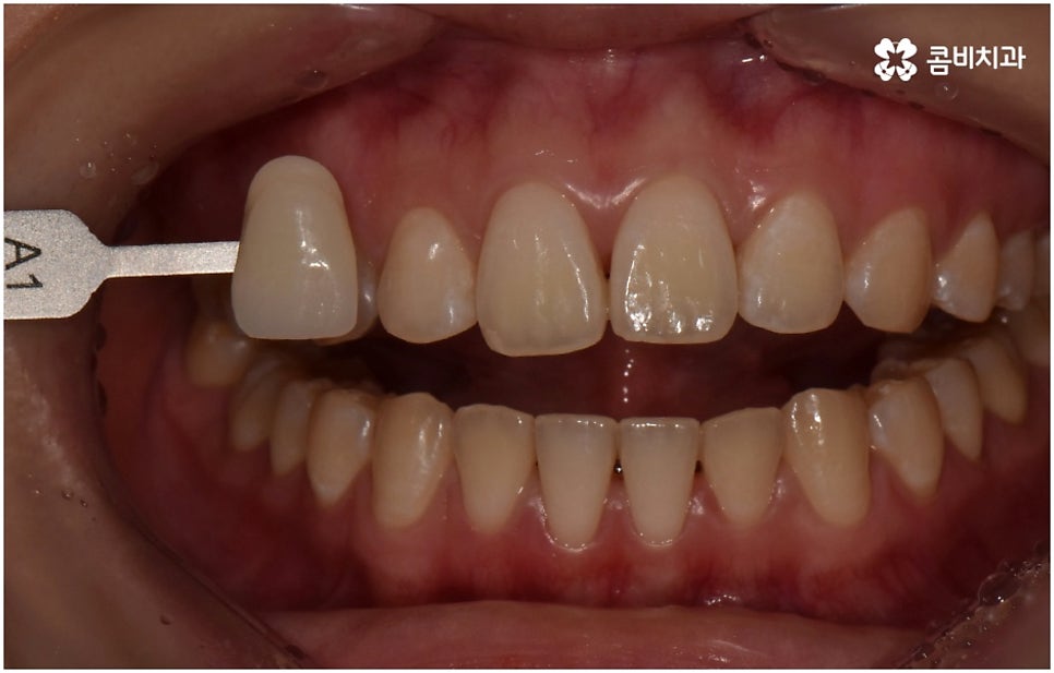 누런치아 하얗게 바꾸고 싶다면 관련 이미지 6