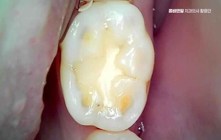 명동치과 흔하게 놓치는 사례를 정리해요 관련 이미지 8