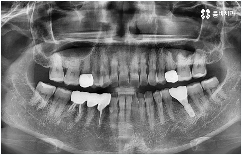 원데이임플란트 받고 싶으신가요? 관련 이미지 12