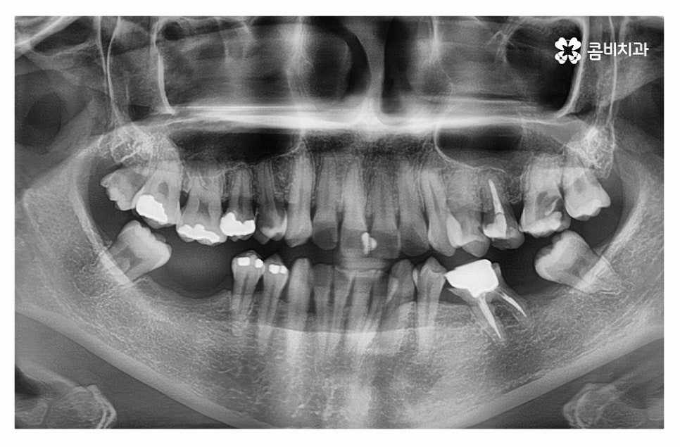 임플란트종류 잘알아보고 적용하려면 관련 이미지 1