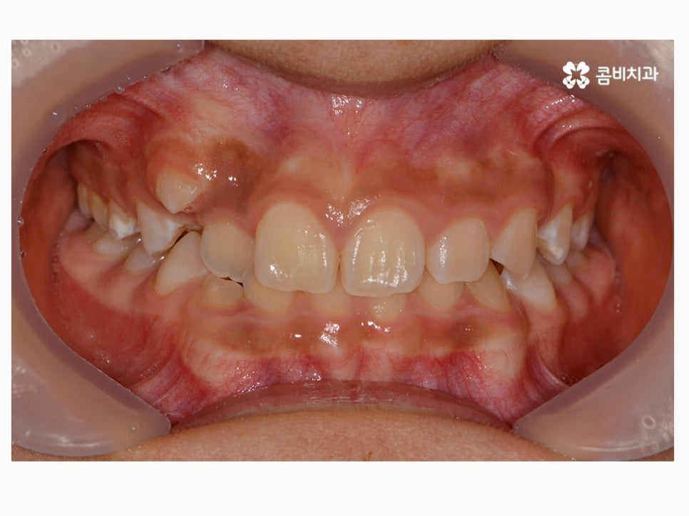 과개교합교정 어릴때 고쳐주면 좋은 사례 관련 이미지 1