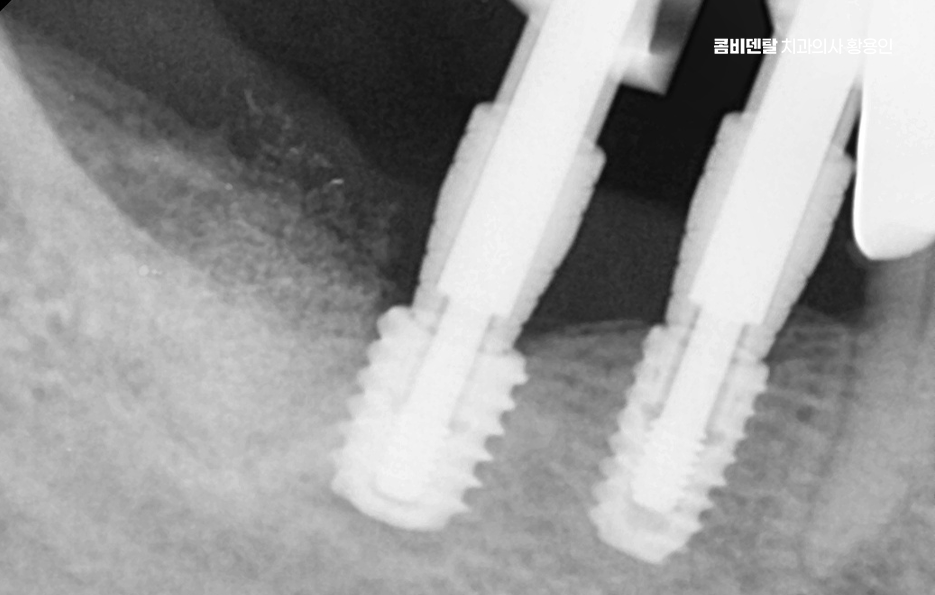 어금니 임플란트 뼈이식 이럴때 해당됩니다 관련 이미지 8