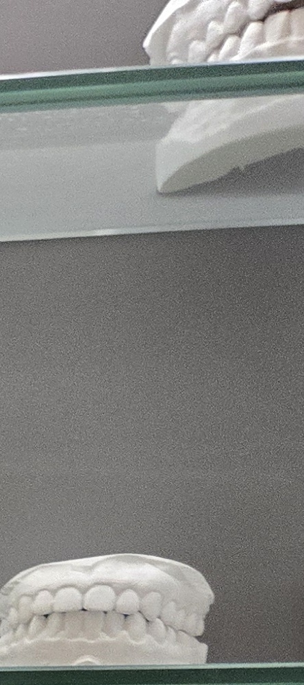 앞이빨 임플란트 과정 주의해야할 포인트는 관련 이미지 16