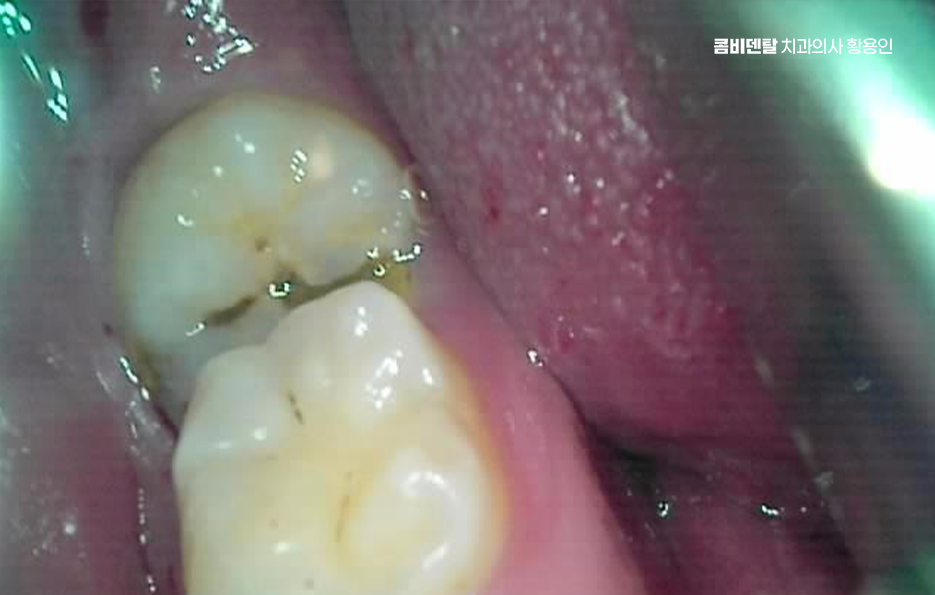 사랑니 발치 후 충치 치료 둘다 준비하려면 관련 이미지 6