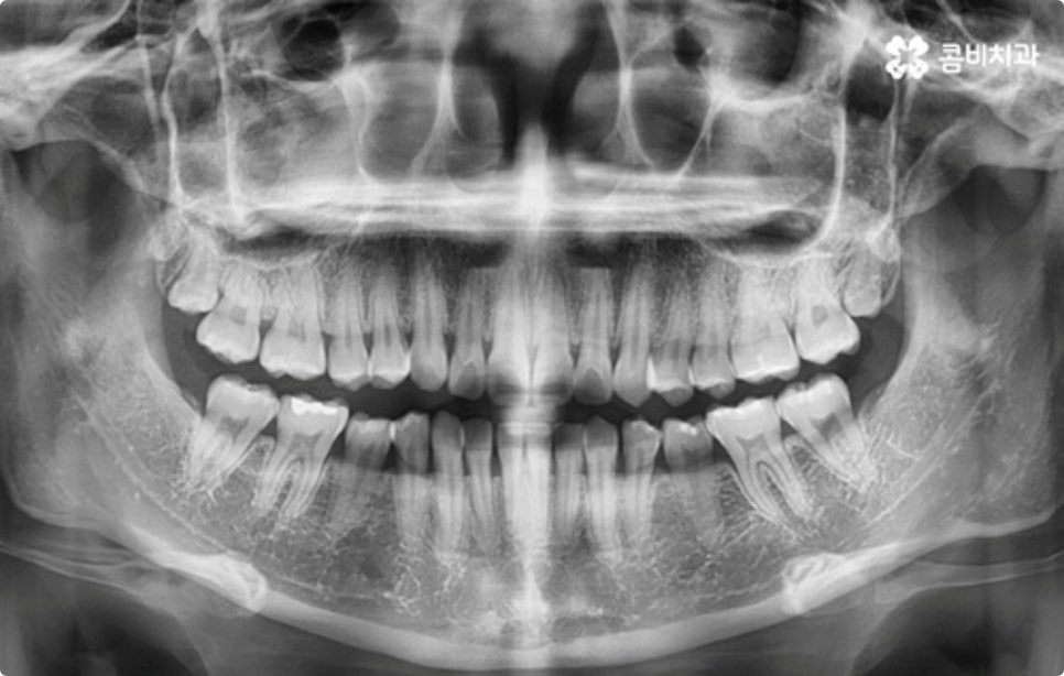 직장인치아교정 어떻게 시작하나요? 관련 이미지 2