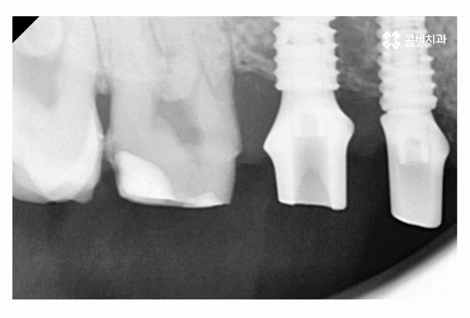 20대임플란트 갈수록 늘어나는 이유는 관련 이미지 11
