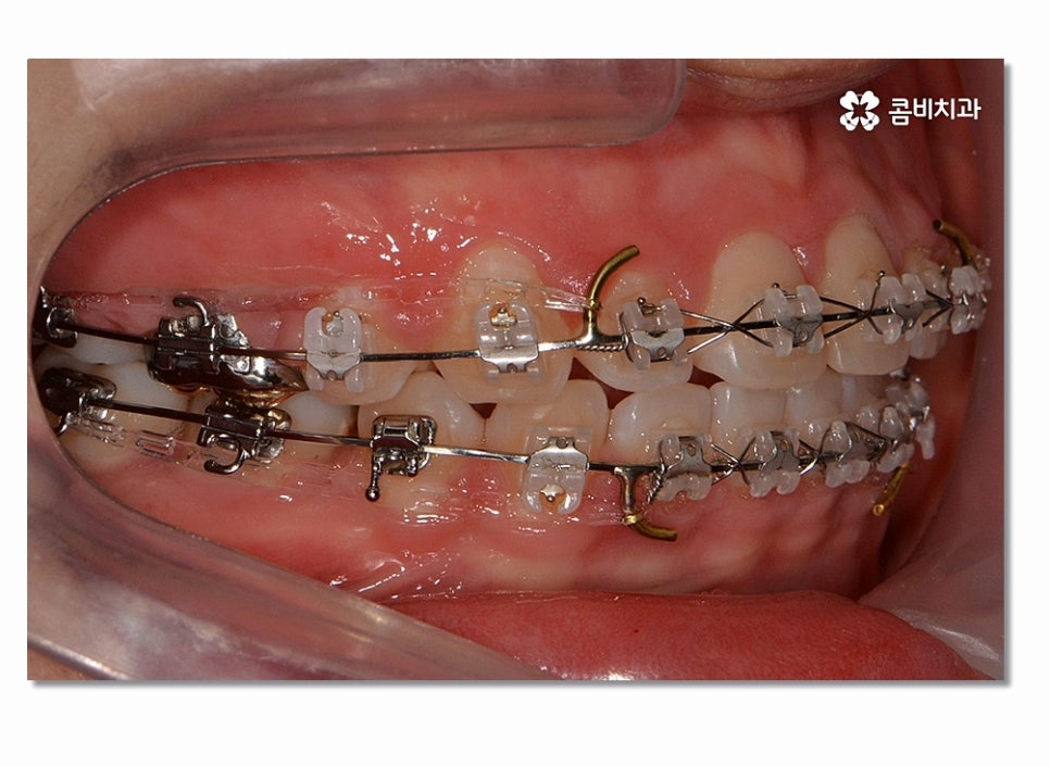 돌출입치아교정 부담이 크게 느껴진다면 관련 이미지 8