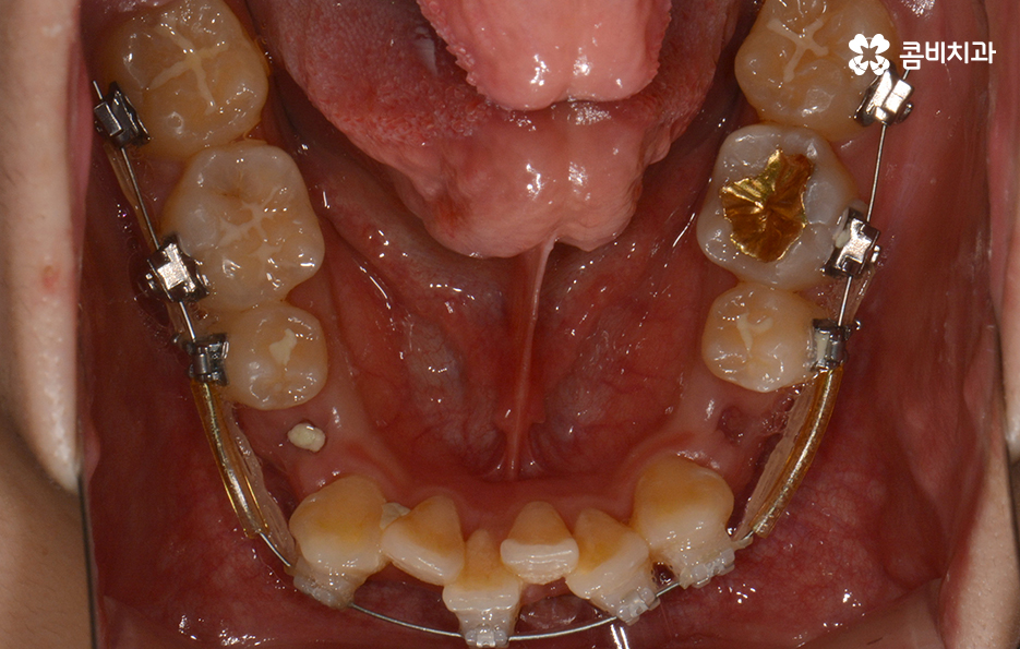 덧니교정 불편함이 느껴지지 않더라도 관련 이미지 11