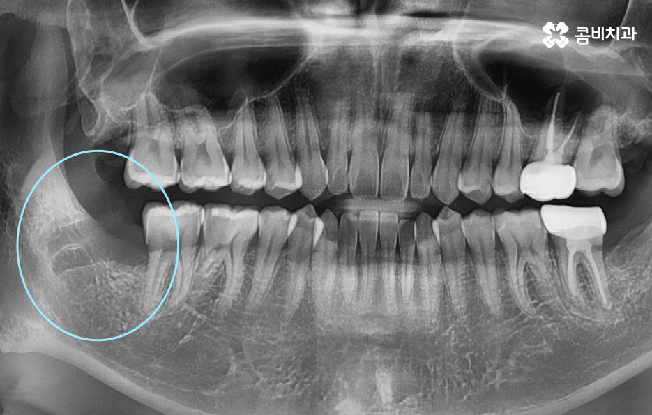 부분매복 사랑니 발치 신중하게 대비하려면 관련 이미지 6