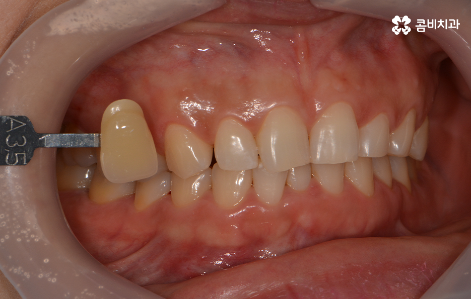 치과치아미백 어떻게 다른지 설명해드려요 관련 이미지 5