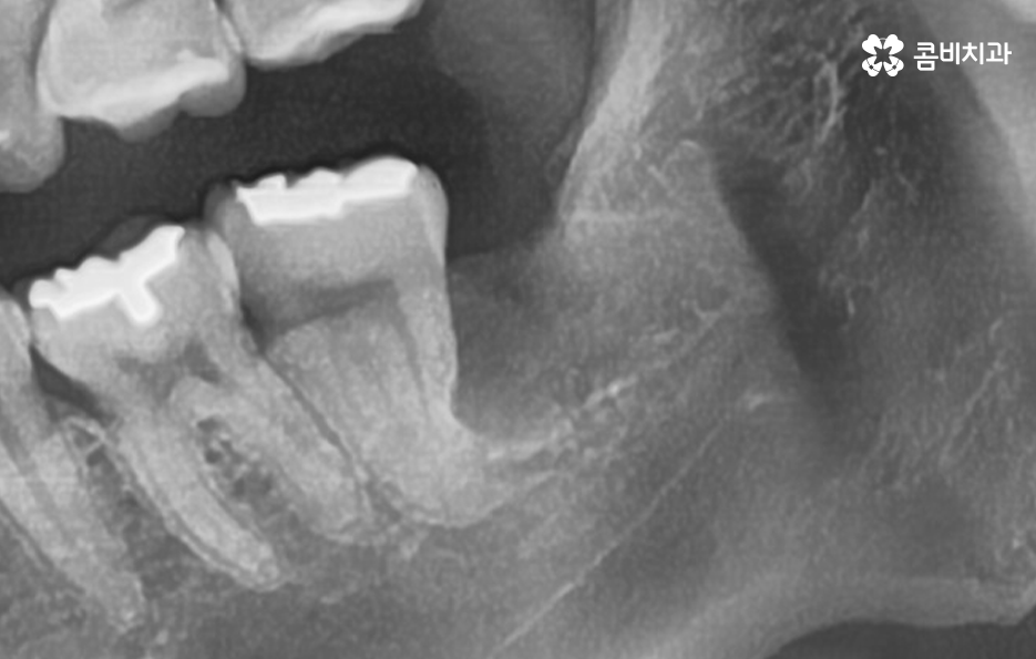 누워있는 사랑니 꼭 뽑아야 하는 경우는 언제일까 관련 이미지 5