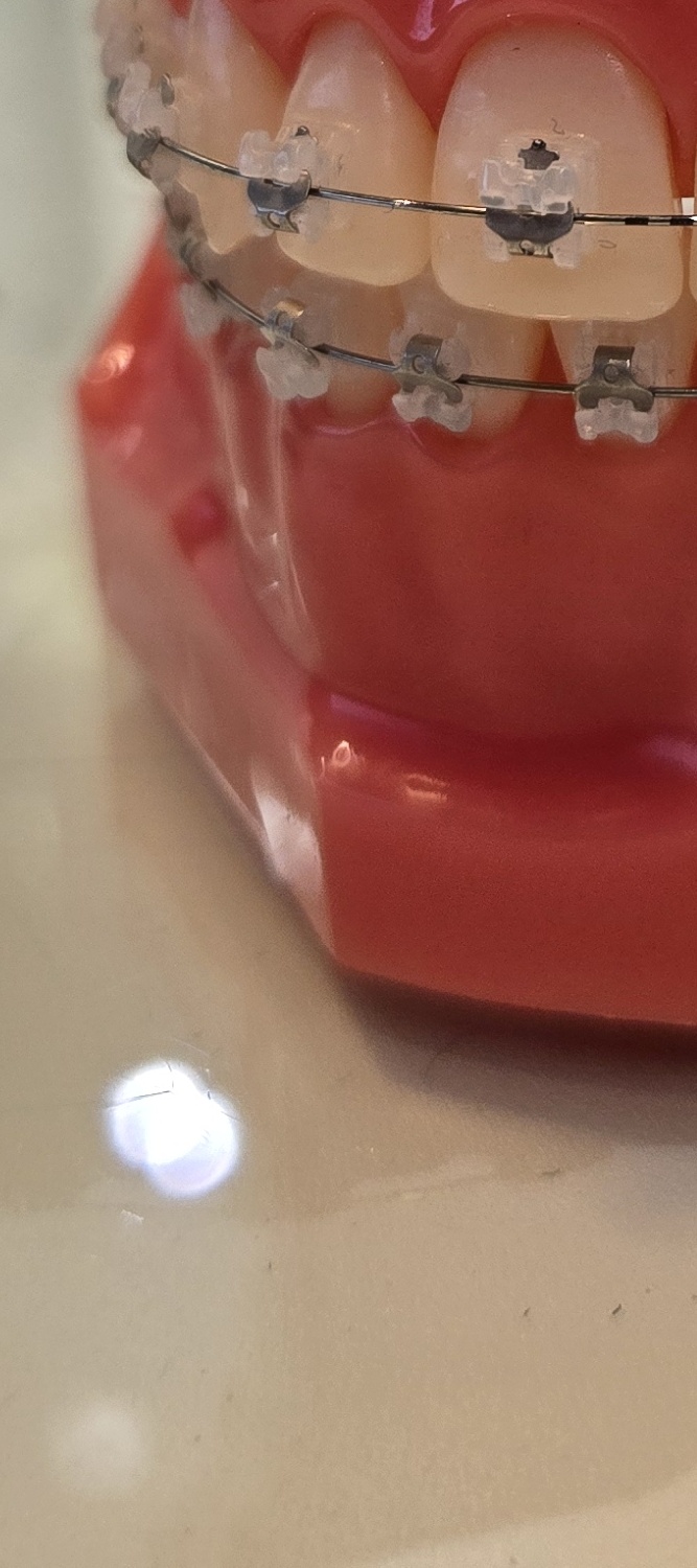 송곳니 덧니 발치 이럴때 해당되네요 관련 이미지 32