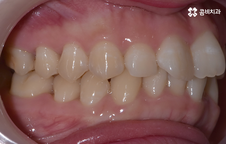 앞니 틀어짐 교정으로 해결하면 될까요 관련 이미지 2