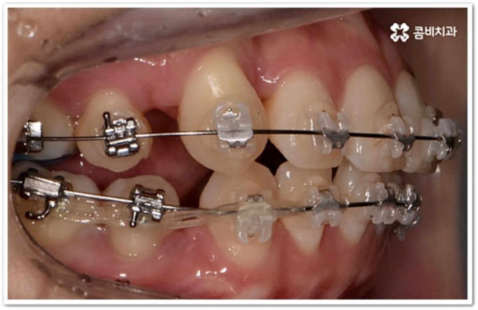 덧니 발치 언제 하나요? 관련 이미지 6