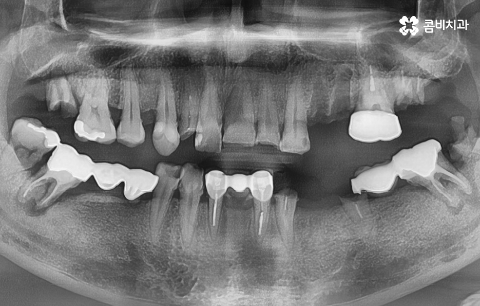 임플란트 치조골 상태에 따라 치료 계획도 달라지나요 관련 이미지 1