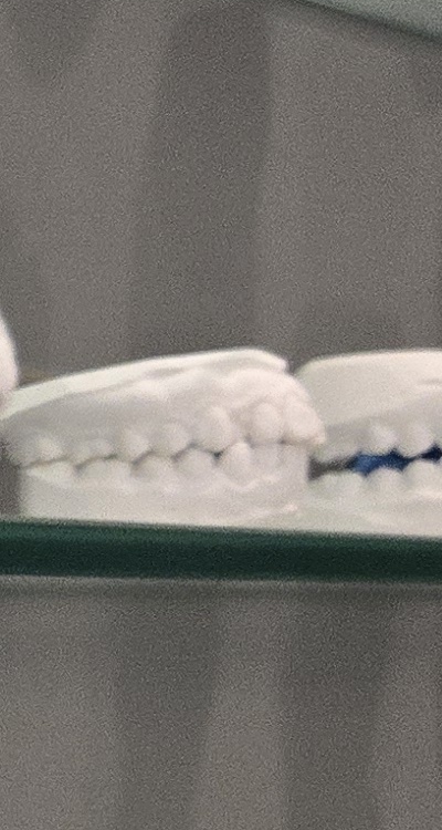 사랑니 주변 잇몸 통증 지금부터가 중요하니까 관련 이미지 29