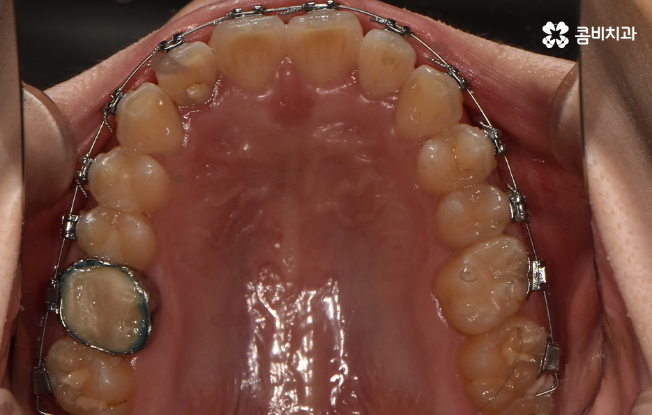 앞니 틀어짐 교정으로 해결하면 될까요 관련 이미지 10