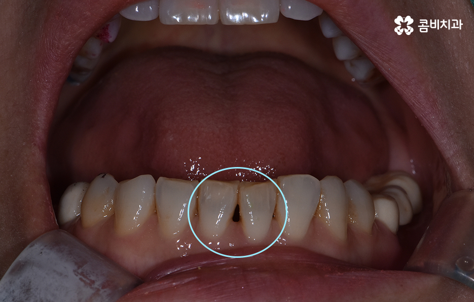 블랙트라이앵글 레진으로 해결한 사례 관련 이미지 1