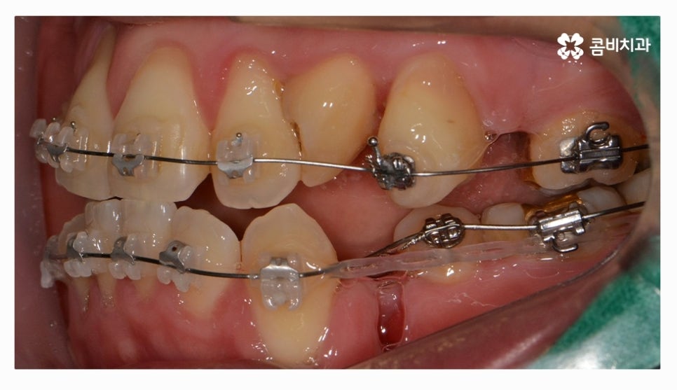 클리피씨교정 올바르게 판단하려면 관련 이미지 9