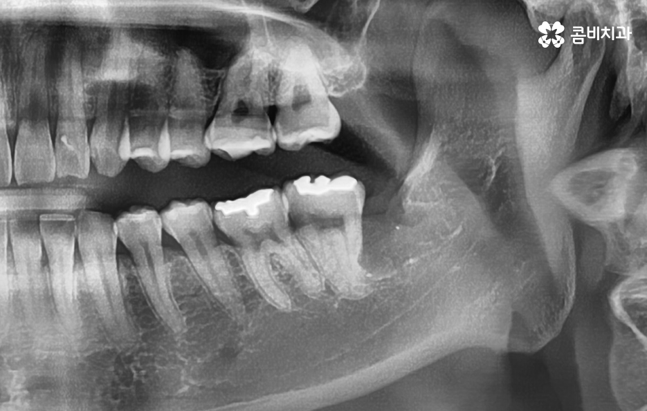 누워있는 사랑니 꼭 뽑아야 하는 경우는 언제일까 관련 이미지 4